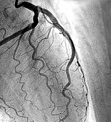 Coronary Angiogram