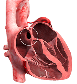 Atrial Septal Defect (ASD)