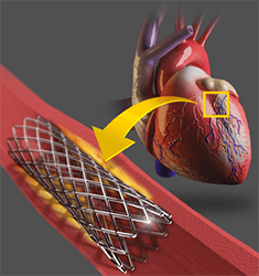 Coronary Stenting