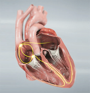 Arrhythmia