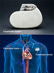 Permanent Pacemaker