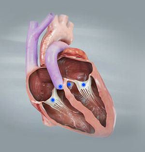 Valvular Heart Disease (VHD)